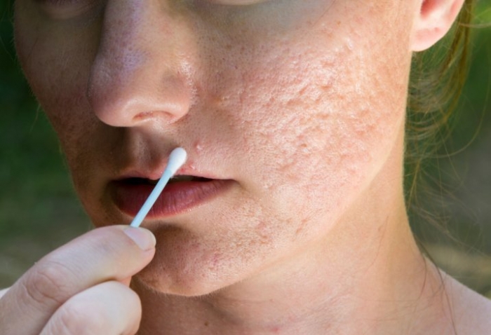 Rimedi e consigli ayurvedici contro l'acne